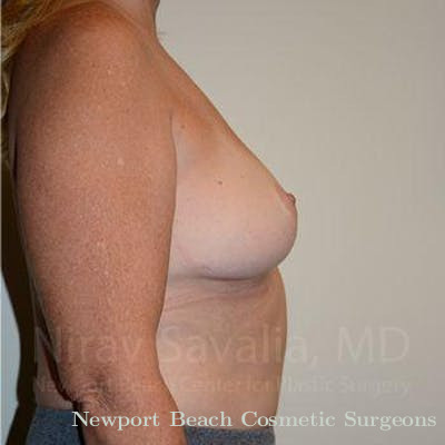 Facelift Before & After Gallery - Patient 1655446 - After