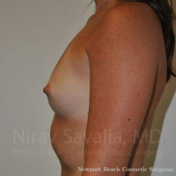 Mastectomy Reconstruction Revision Before & After Gallery - Patient 1655445 - Before