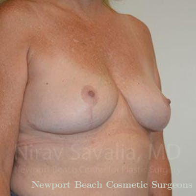 Breast Explantation En Bloc Capsulectomy Before & After Gallery - Patient 1655446 - After
