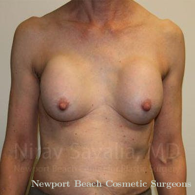 Breast Implant Revision Before & After Gallery - Patient 1655447 - Before