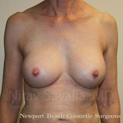 Liposuction Before & After Gallery - Patient 1655447 - After