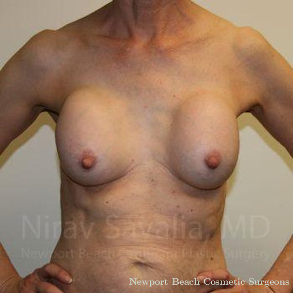 Mastectomy Reconstruction Revision Before & After Gallery - Patient 1655447 - Before