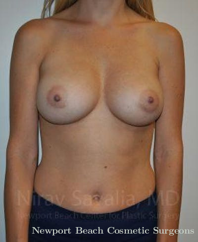 Breast Lift with Implants Before & After Gallery - Patient 1655448 - After