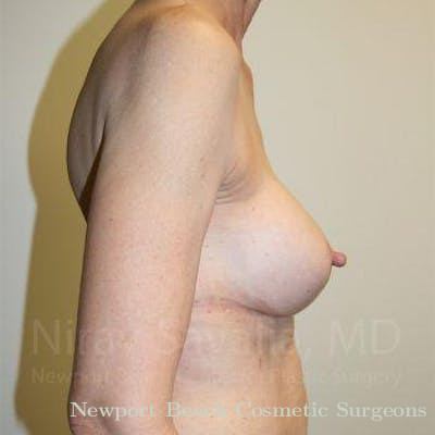 Breast Implant Revision Before & After Gallery - Patient 1655447 - After