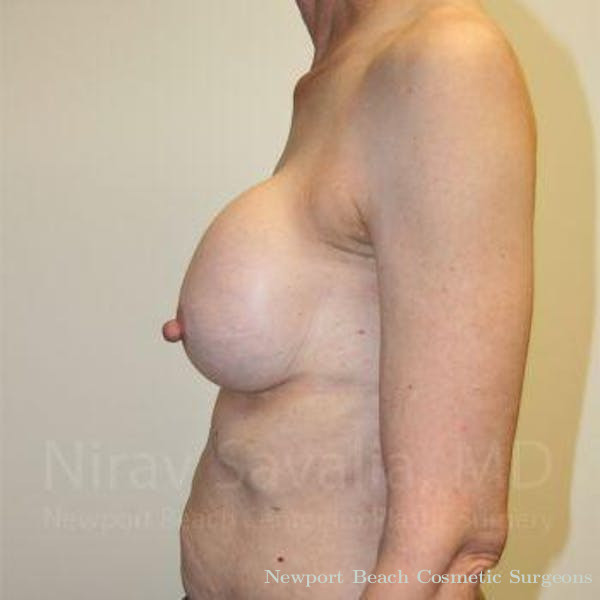 Breast Explantation En Bloc Capsulectomy Before & After Gallery - Patient 1655447 - Before