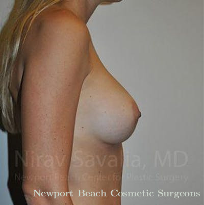 Breast Explantation En Bloc Capsulectomy Before & After Gallery - Patient 1655448 - After