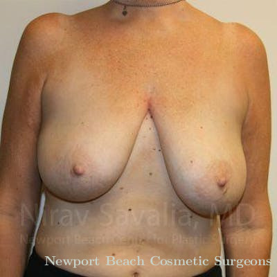 Breast Reduction Before & After Gallery - Patient 1655450 - Before