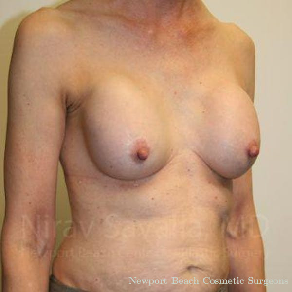 Breast Implant Revision Before & After Gallery - Patient 1655447 - Before