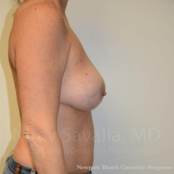 Breast Explantation En Bloc Capsulectomy Before & After Gallery - Patient 1655449 - Before