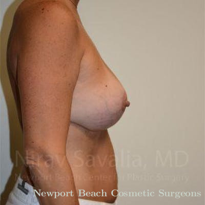 Facelift Before & After Gallery - Patient 1655449 - After