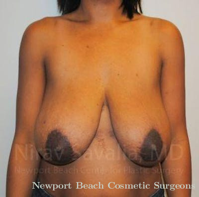 Breast Implant Revision Before & After Gallery - Patient 1655451 - Before
