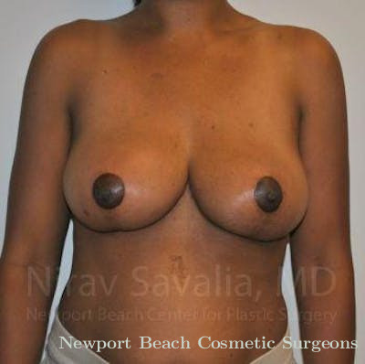Breast Reduction Before & After Gallery - Patient 1655451 - After