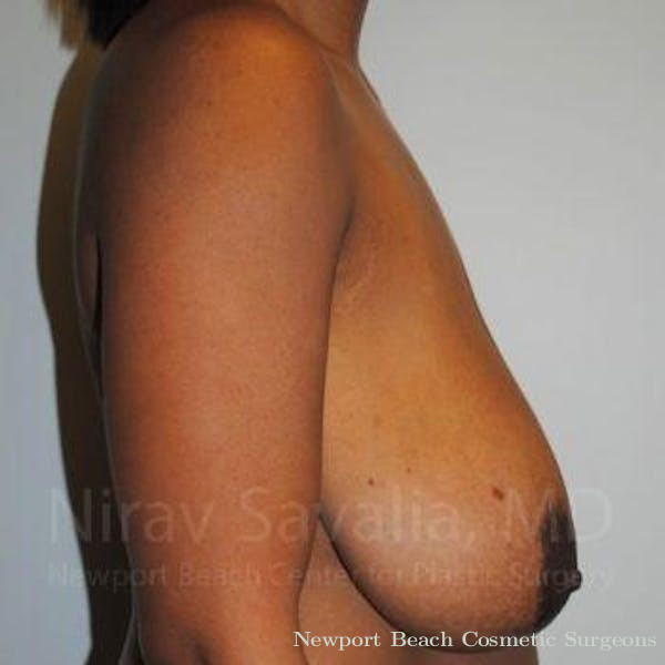 Breast Augmentation Before & After Gallery - Patient 1655451 - Before