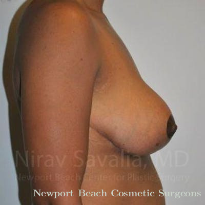 Breast Lift without Implants Before & After Gallery - Patient 1655451 - After