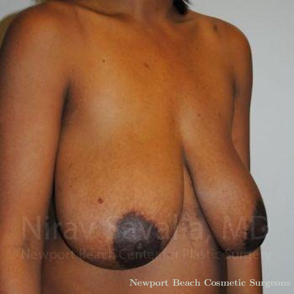 Breast Explantation En Bloc Capsulectomy Before & After Gallery - Patient 1655451 - Before