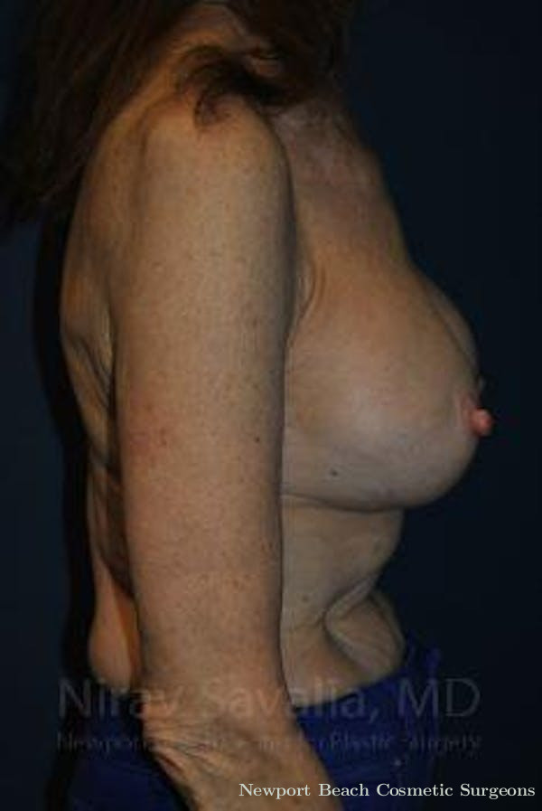 Mastectomy Reconstruction Revision Before & After Gallery - Patient 1655452 - Before