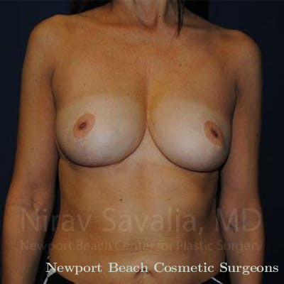 Mastectomy Reconstruction Before & After Gallery - Patient 1655454 - After