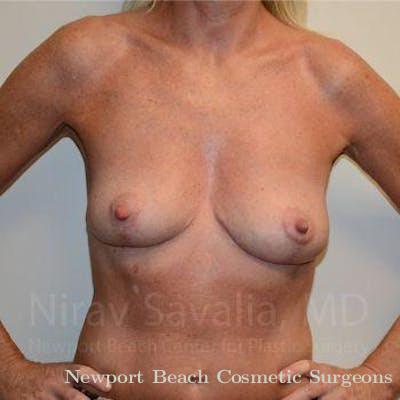 Mastectomy Reconstruction Revision Before & After Gallery - Patient 1655456 - After