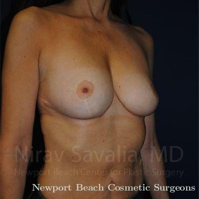 Mastectomy Reconstruction Revision Before & After Gallery - Patient 1655454 - After
