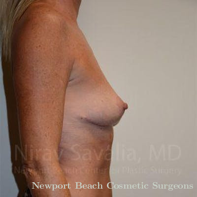Facelift Before & After Gallery - Patient 1655456 - After