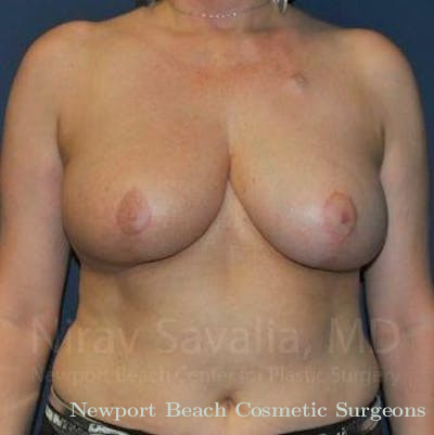 Breast Explantation En Bloc Capsulectomy Before & After Gallery - Patient 1655461 - After