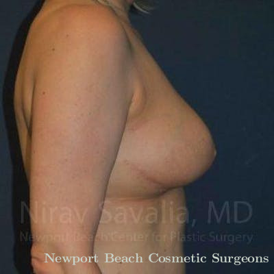 Breast Lift with Implants Before & After Gallery - Patient 1655461 - After