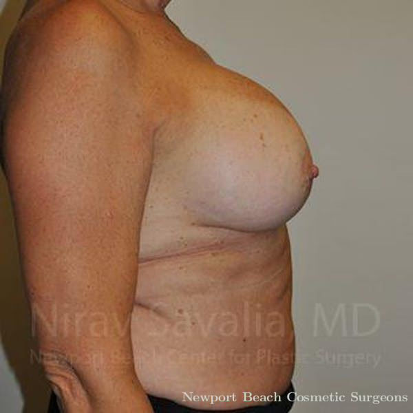 Breast Augmentation Before & After Gallery - Patient 1655463 - Before