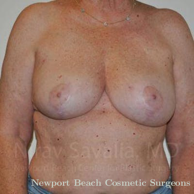 Breast Lift without Implants Before & After Gallery - Patient 1655457 - After