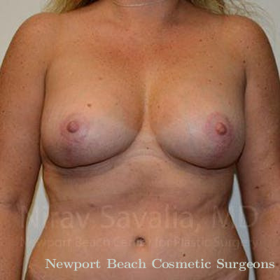 Breast Implant Revision Before & After Gallery - Patient 1655460 - After