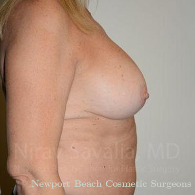 Mastectomy Reconstruction Before & After Gallery - Patient 1655463 - After