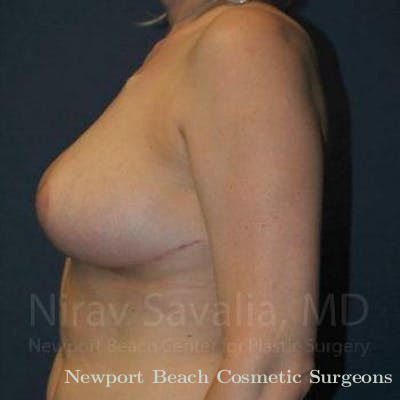 Breast Reduction Before & After Gallery - Patient 1655461 - After