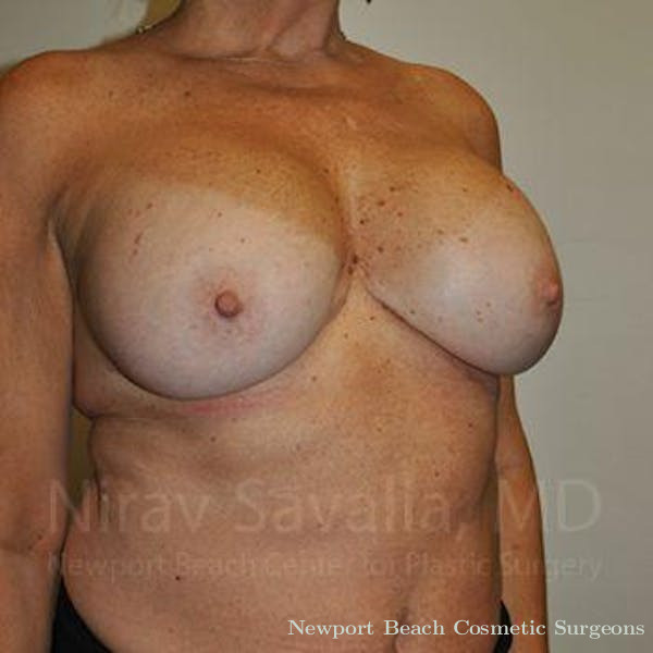 Breast Explantation En Bloc Capsulectomy Before & After Gallery - Patient 1655463 - Before