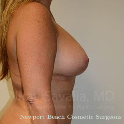 Fat Grafting to Face Before & After Gallery - Patient 1655460 - After