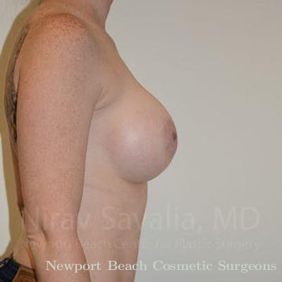 Breast Lift with Implants Before & After Gallery - Patient 1655459 - After