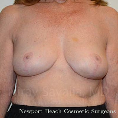Oncoplastic Reconstruction Before & After Gallery - Patient 1655462 - After