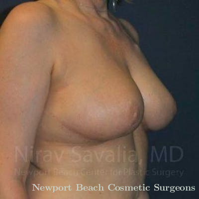 Oncoplastic Reconstruction Before & After Gallery - Patient 1655461 - After
