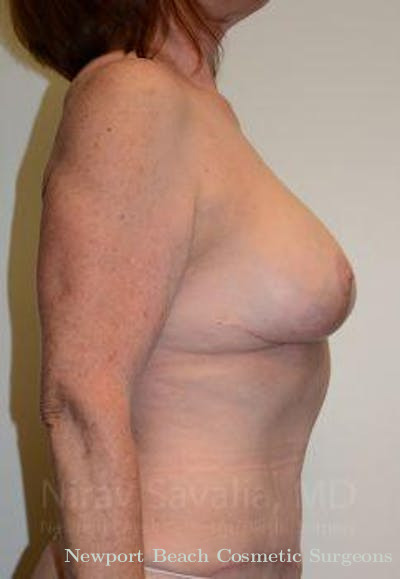 Breast Lift with Implants Before & After Gallery - Patient 1655458 - After