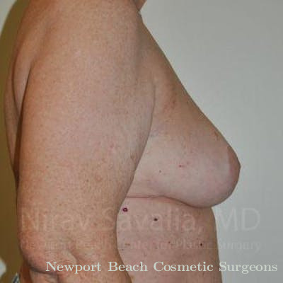 Breast Implant Revision Before & After Gallery - Patient 1655457 - After