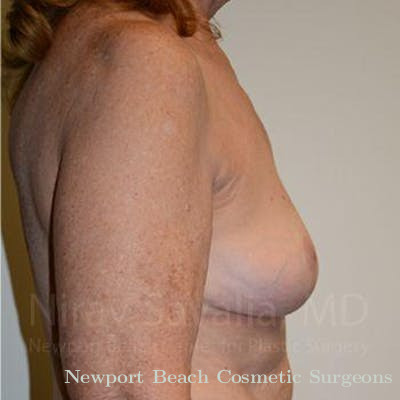 Breast Lift without Implants Before & After Gallery - Patient 1655462 - After