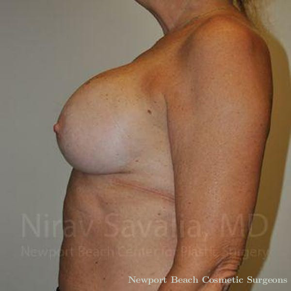Breast Explantation En Bloc Capsulectomy Before & After Gallery - Patient 1655463 - Before
