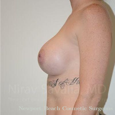 Male Breast Reduction Before & After Gallery - Patient 1655459 - After
