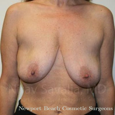 Breast Explantation En Bloc Capsulectomy Before & After Gallery - Patient 1655465 - Before