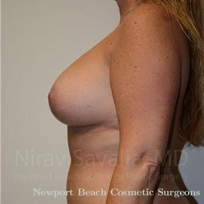 Breast Lift without Implants Before & After Gallery - Patient 1655460 - After