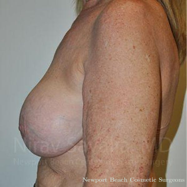 Breast Implant Revision Before & After Gallery - Patient 1655462 - Before