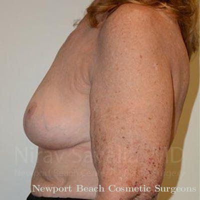 Facelift Before & After Gallery - Patient 1655462 - After