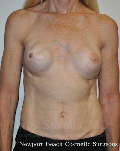 Oncoplastic Reconstruction Before & After Gallery - Patient 1655466 - Before
