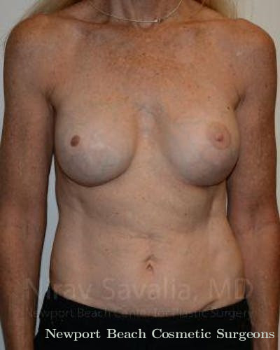 Fat Grafting to Face Before & After Gallery - Patient 1655466 - After