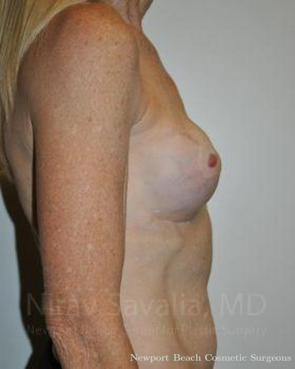 Mastectomy Reconstruction Before & After Gallery - Patient 1655466 - Before