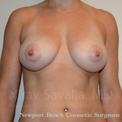 Oncoplastic Reconstruction Before & After Gallery - Patient 1655469 - After