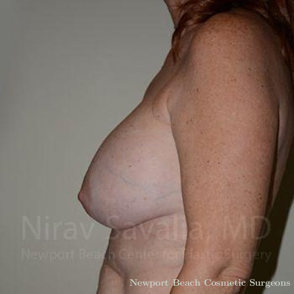 Breast Augmentation Before & After Gallery - Patient 1655467 - Before